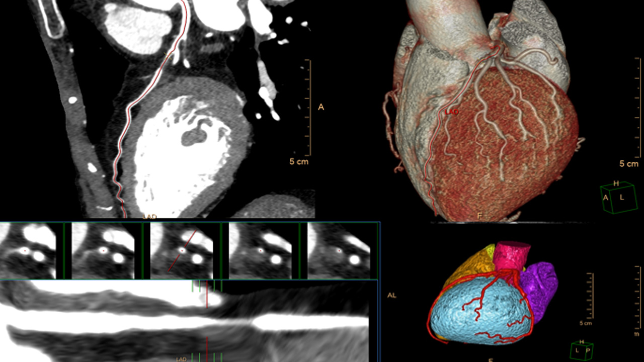 RSNA